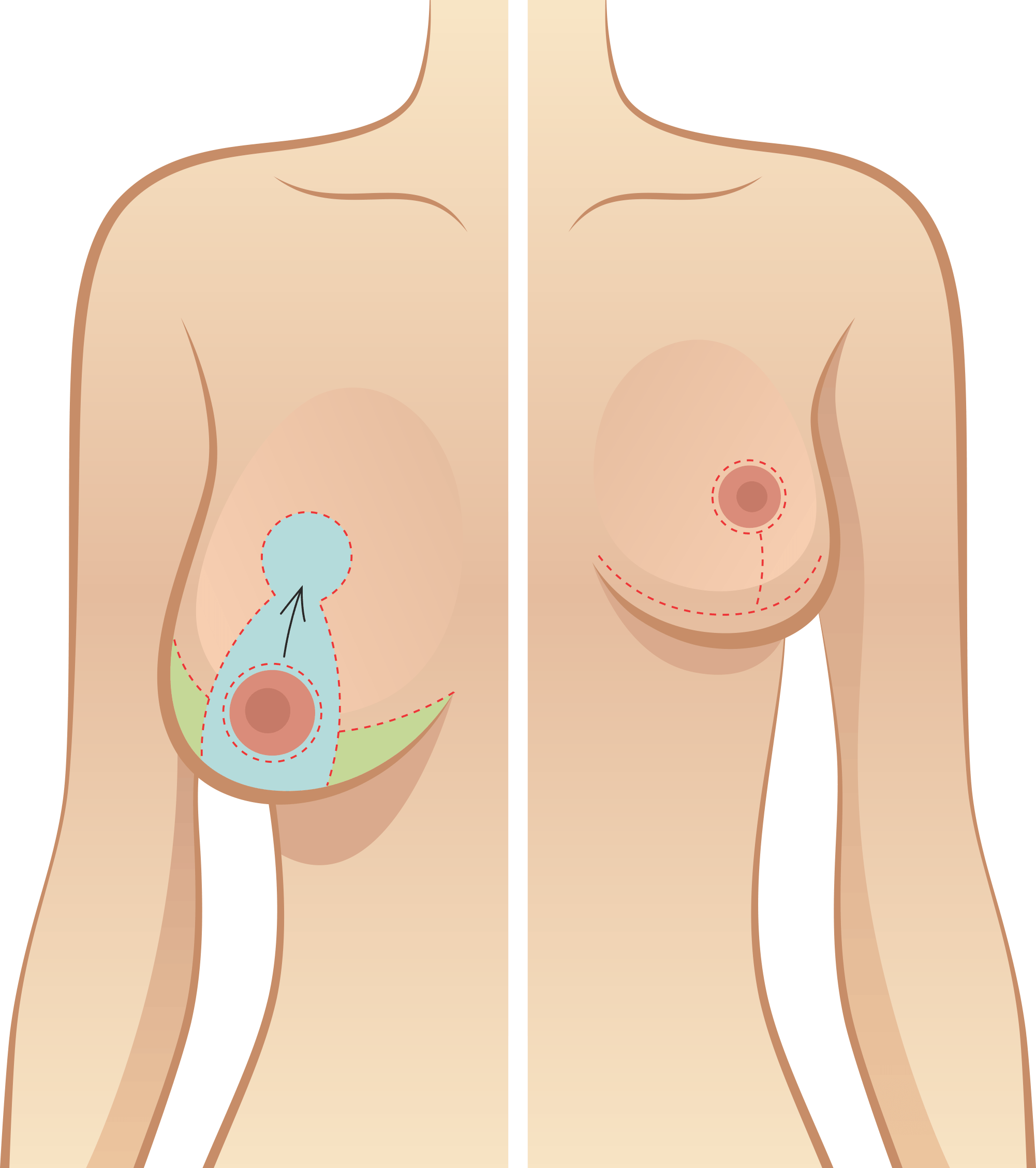 Surgical incisions for reduction mammoplasty. (a) An incision is