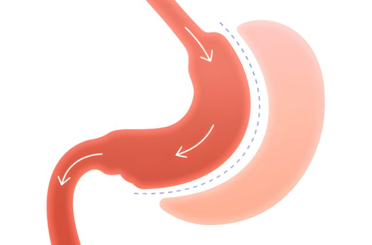 Weight Loss Surgery in Turkey: Who Is a Candidate for Bariatric Surgery?