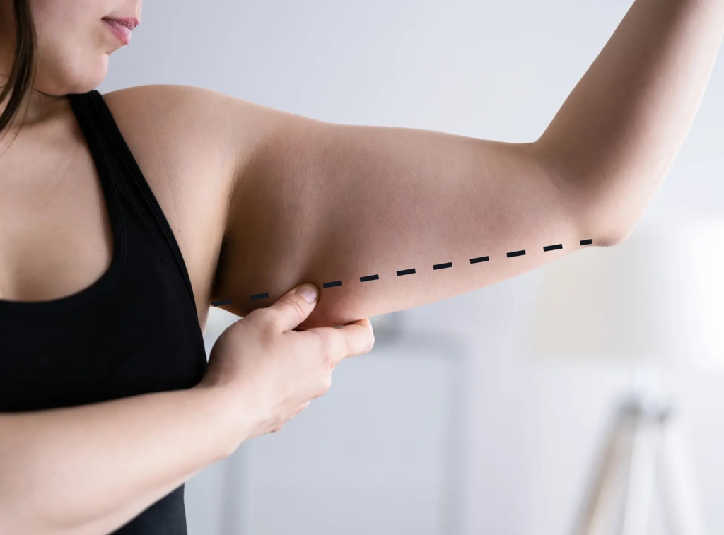 How to Prepare for Arm Lift Surgery: Risks and Complications of Brachioplasty