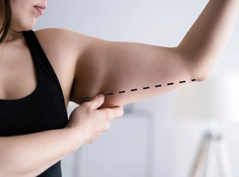 How to Prepare for Arm Lift Surgery: Risks and Complications of Brachioplasty