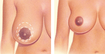 A circular pattern around the areola