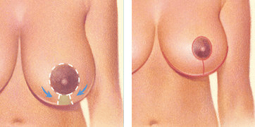 A keyhole pattern with an incision around the areola and vertically down to the breast crease
