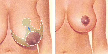 An inverted T or anchor-shaped incision pattern